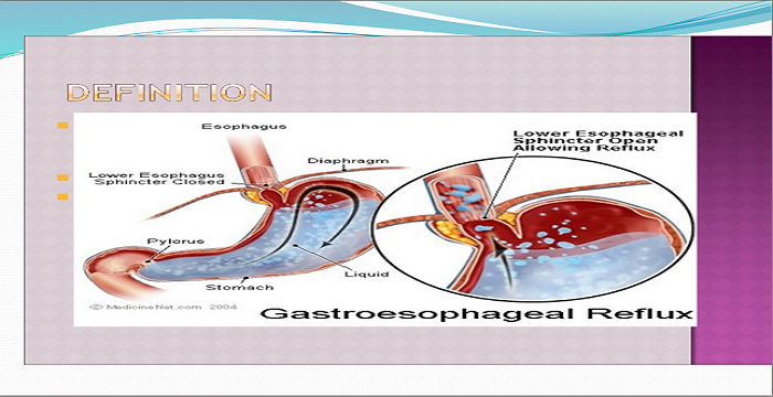 Myocardial Infarction