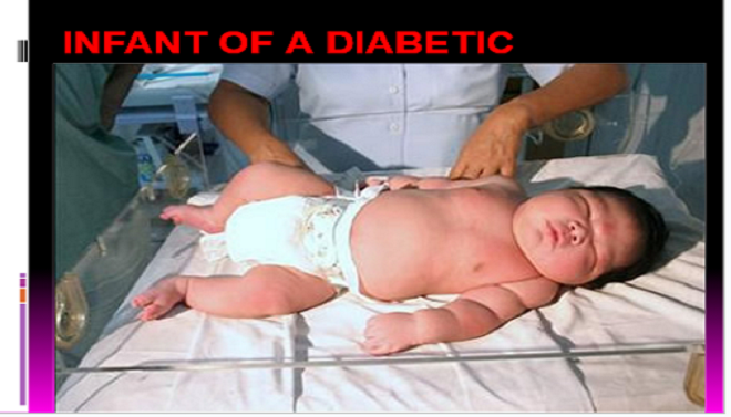 INFANT_OF_A_DIABETIC_MOTHER